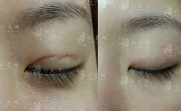 疤痕修復(fù)手術(shù)過程是怎么樣的? 疤痕修復(fù)手術(shù)過程是怎么樣的?