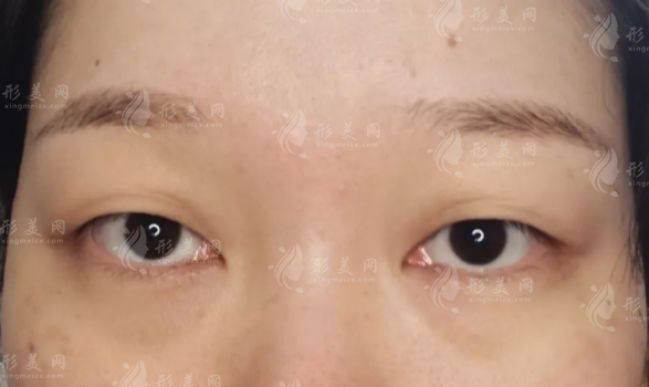 內(nèi)切去眼袋有手術(shù)風(fēng)險嗎?做完需要多久才能恢復(fù)~ 內(nèi)切去眼袋有手術(shù)風(fēng)險嗎?做完需要多久才能恢復(fù)~