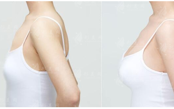 自體脂肪注射隆胸比假體的手感更好嗎?哪個(gè)比較好?