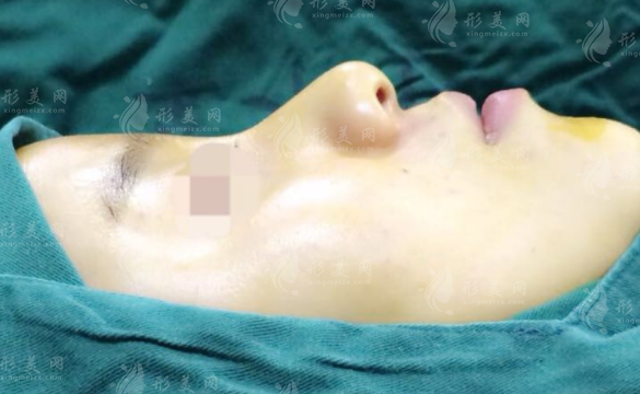 歪鼻整形需要多久恢復(fù)？