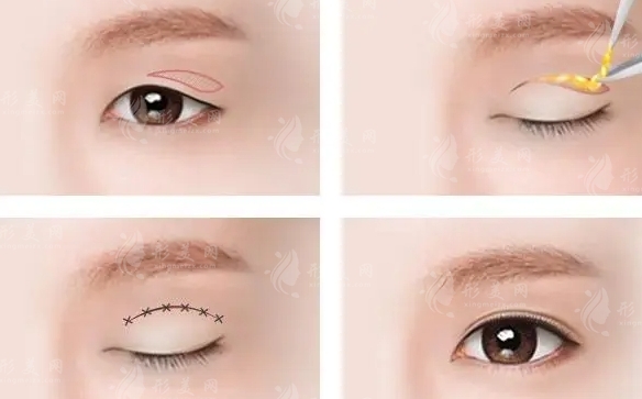 上瞼下垂矯正后遺癥有哪些？