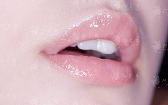 自體脂肪豐唇珠能維持多久? 自體脂肪豐唇珠能維持多久?