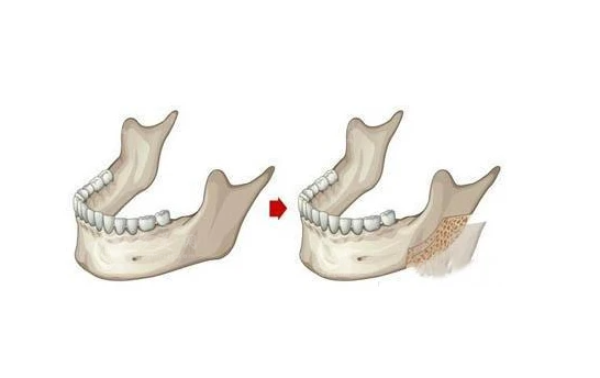 四川友誼羅恩磨骨怎么樣？羅恩醫(yī)生磨骨優(yōu)勢與價格為您一并介紹