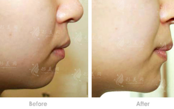 假體豐下巴出現(xiàn)哪些情況需要將假體取出？