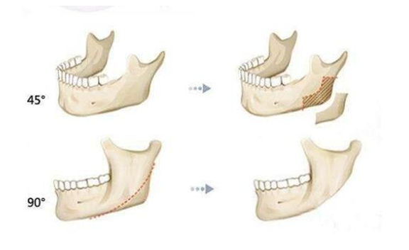 北京張笑天磨骨怎么樣？