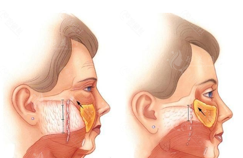 上海第九人民醫(yī)院拉皮：30000元起，告別皺紋困擾！