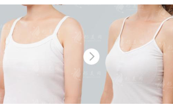 隆胸手術(shù)切口選擇：腋下切口與下皺襞切口之比較
