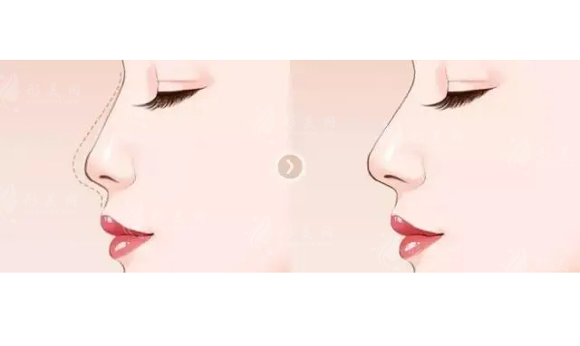 上海九院假體隆鼻術(shù)前攻略