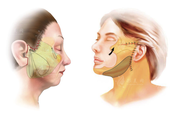 李健醫(yī)生做面部/腹部拉皮有什么技術特色？