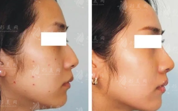 冷凍去痣幾天能脫落及術(shù)后注意事項(xiàng)