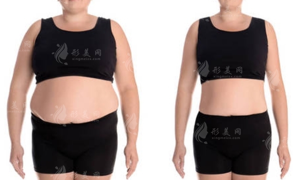 專業(yè)吸脂減肥塑身：注意事項(xiàng)與術(shù)后護(hù)理