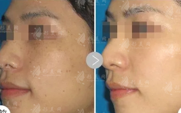 光子嫩膚可以去除斑點(diǎn)嗎？需要做多少次？術(shù)后效果怎么樣？