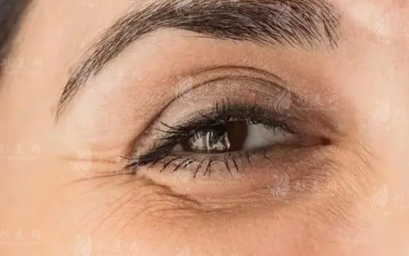 眼部除皺：探索好的方式與價(jià)格，對比效果優(yōu)劣