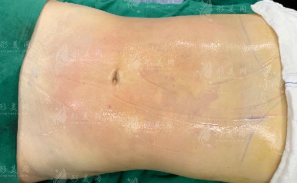 做腹部吸脂術(shù)的方法，及術(shù)后注意事項(xiàng)都有什么呢？