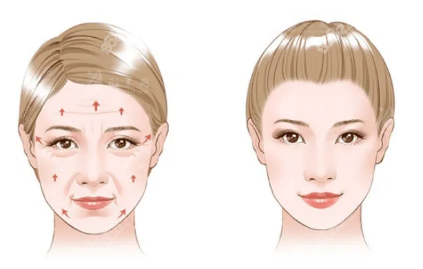 北京加減美面部提升：V9與V6怎么選？從切口大小與價(jià)格優(yōu)勢(shì)談起