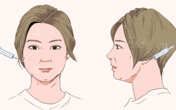 上海九院做面部吸脂技術如何？口碑醫(yī)生、整形問答、附價格表