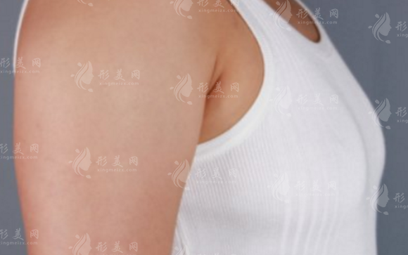 自體脂肪隆胸與假體隆胸：兩者之間的區(qū)別