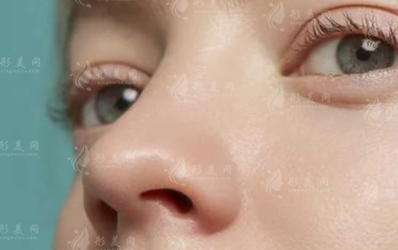 耳軟骨墊鼻尖取出后的恢復時間探討