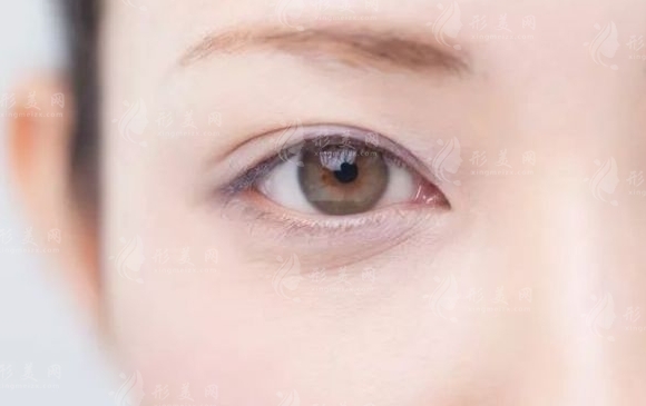 眼瞼吸脂會導(dǎo)致皮膚下垂嗎？下垂怎么辦？