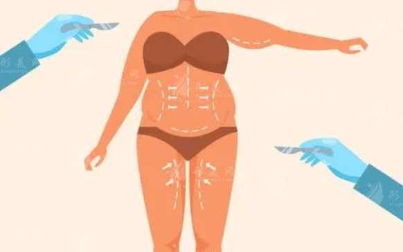 抽脂術(shù)后為何需要穿塑身衣及其作用解析