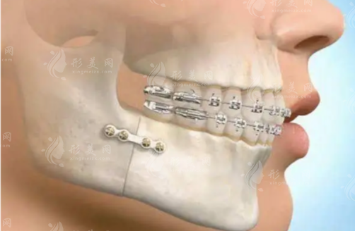 重慶松山醫(yī)院在正頜手術(shù)