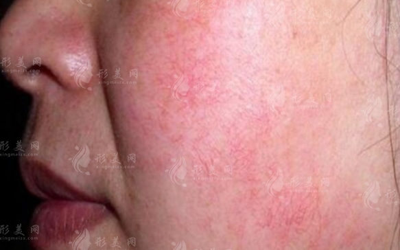 激光去除紅血絲：安全性探討與潛在影響分析