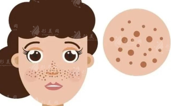 激光祛斑反黑現(xiàn)象解析