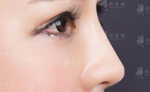 耳軟骨墊鼻尖后恢復期注意事項