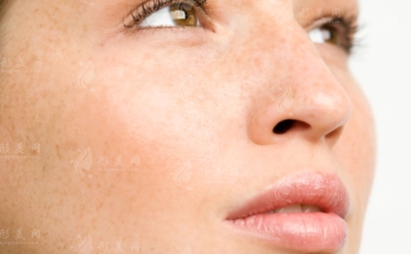 激光祛斑的原理與術(shù)后化妝指南 激光祛斑的原理與術(shù)后化妝指南