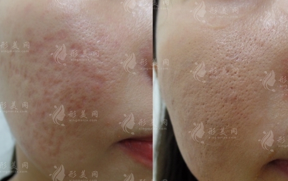 點(diǎn)陣激光可以去除痘坑嗎，效果怎么樣