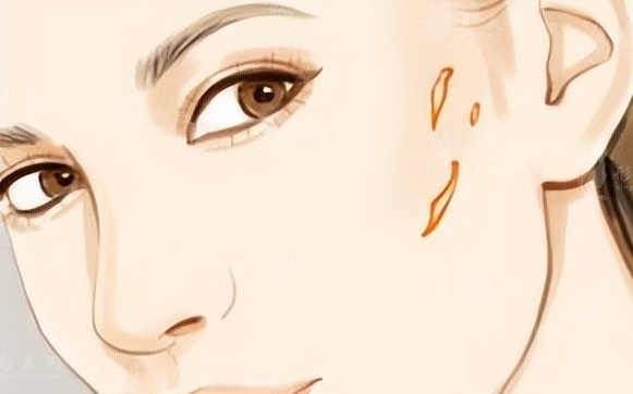 點(diǎn)陣激光祛疤:重塑肌膚的神奇之旅 點(diǎn)陣激光祛疤:重塑肌膚的神奇之旅