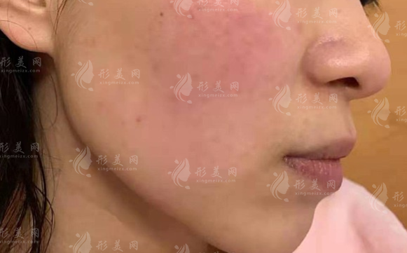 影響光子嫩膚去除紅血絲價(jià)格的因素探究