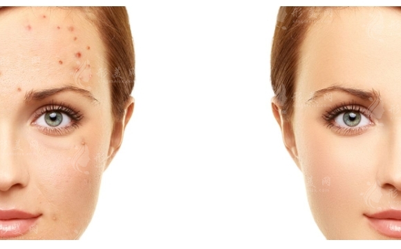 激光祛斑：深入了解其優(yōu)點、缺點與適宜人群