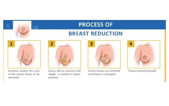 粟勇縮胸手術(shù)技術(shù)怎么樣？