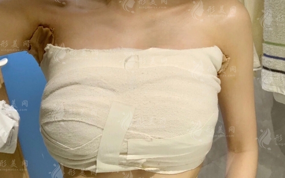 假體隆胸半年后為何還是那么硬?自體脂肪填充與假體隆胸哪個(gè)更優(yōu)?