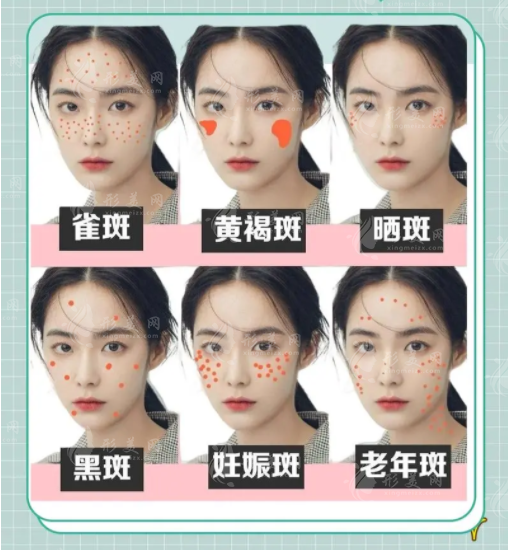 你的色斑是哪種？