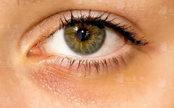 激光去黑眼圈：效果持久性與反彈現(xiàn)象解析