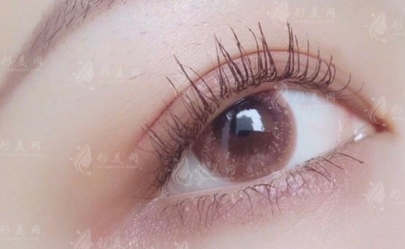 疤痕體質(zhì)可以割雙眼皮嗎？全切雙眼皮手術(shù)費(fèi)用貴嗎？