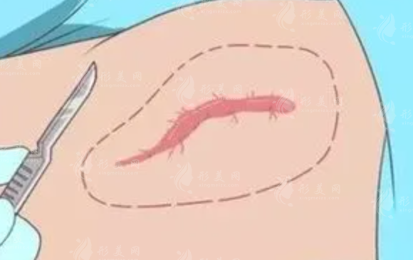 疤痕到底能去除嗎？哪種祛疤方式更靠譜？