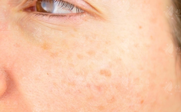 激光祛斑會讓皮膚變薄嗎？術(shù)后應(yīng)該注意什么？