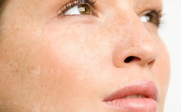 臉上黃褐斑難去除？這些淡斑祛斑方法或許能幫到你