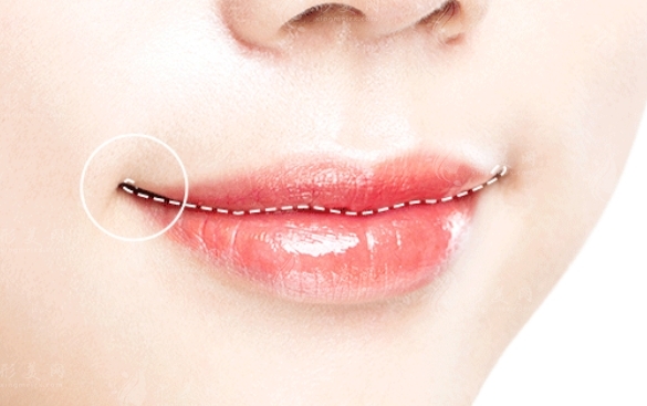 微笑唇手術(shù)后拆線時間及可能的副作用