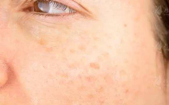 彩光祛斑與激光祛斑：次數(shù)與區(qū)別解析