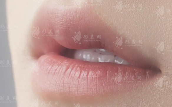 唇珠：適合所有人的美學(xué)密碼，還是因人而異的魅力點(diǎn)綴？