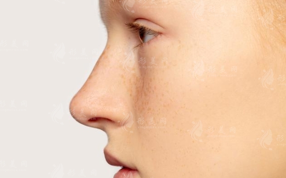 肥厚鼻尖怎么辦？肥厚鼻尖矯正術(shù)多少錢？