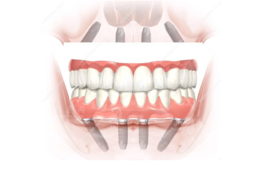 廣州人民醫(yī)院矯正牙齒費(fèi)用多少錢(qián)？項(xiàng)目及牙齒整形技術(shù)優(yōu)勢(shì)分享！