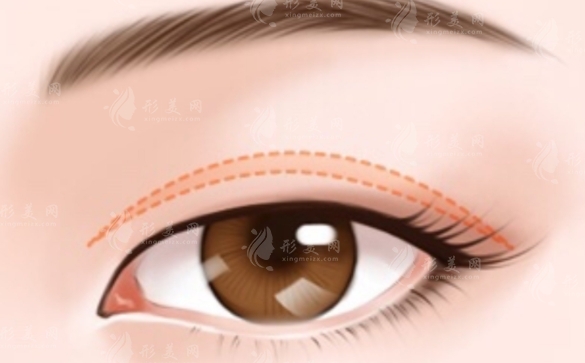 微創(chuàng)雙眼皮多久恢復(fù)自然？微創(chuàng)雙眼皮3天能恢復(fù)自然嗎？