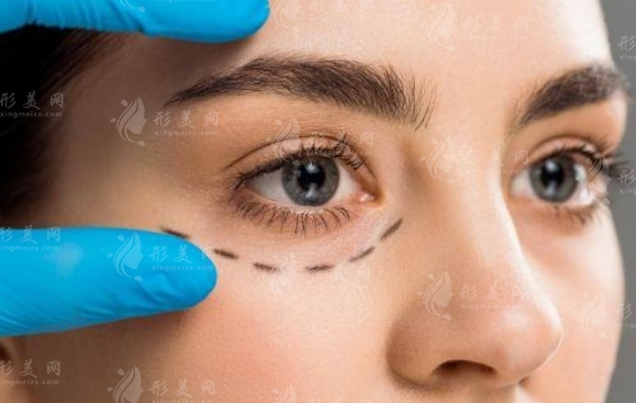 切開(kāi)雙眼皮能修復(fù)好嗎？修切開(kāi)雙眼皮要花多少錢？
