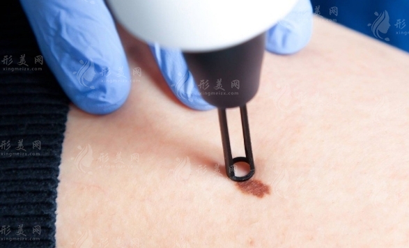 激光點(diǎn)痣：原理與恢復(fù)時(shí)間詳解