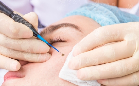 激光點(diǎn)痣后如何避免留疤及選擇醫(yī)院的重要性